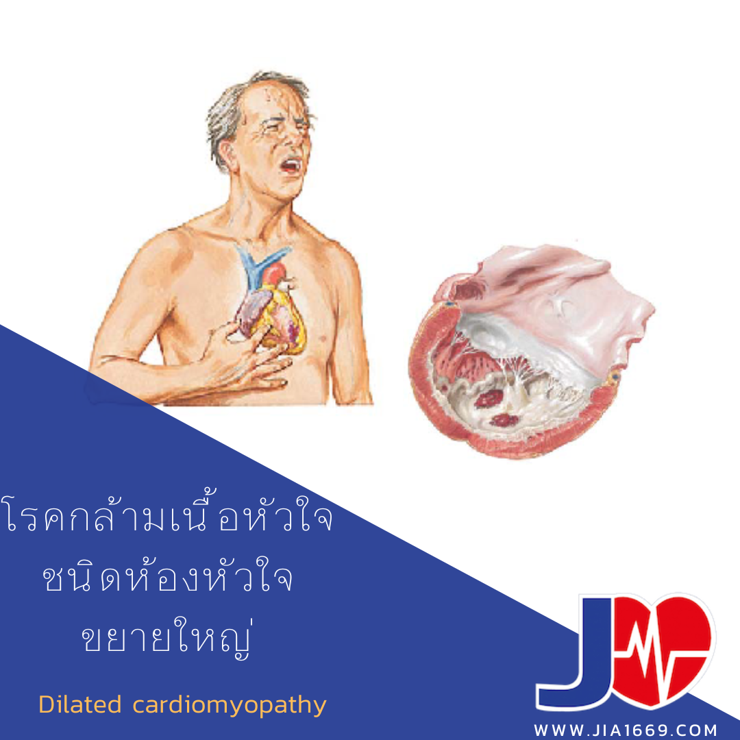 Dilated cardiomyopathy 