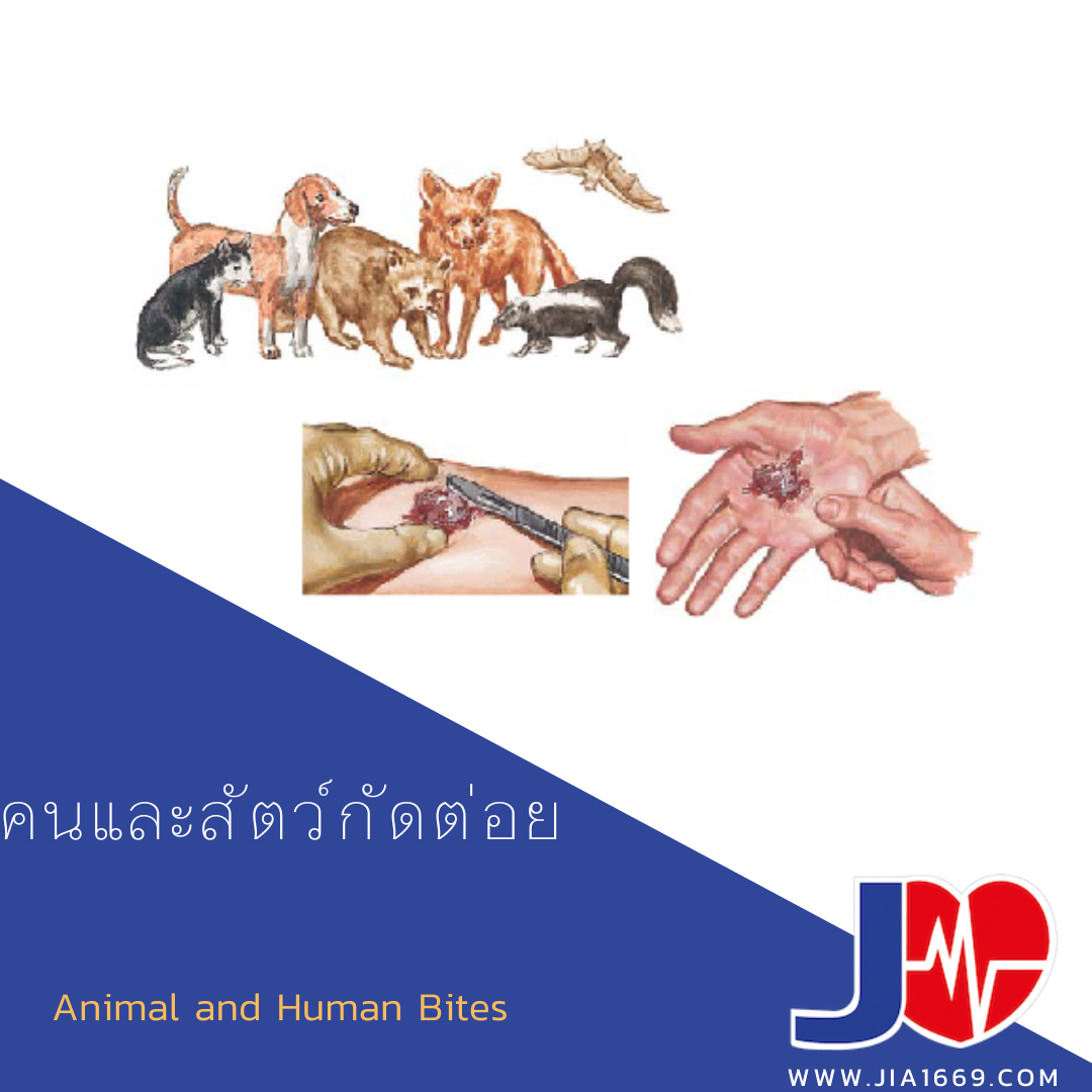 Animal and Human Bites