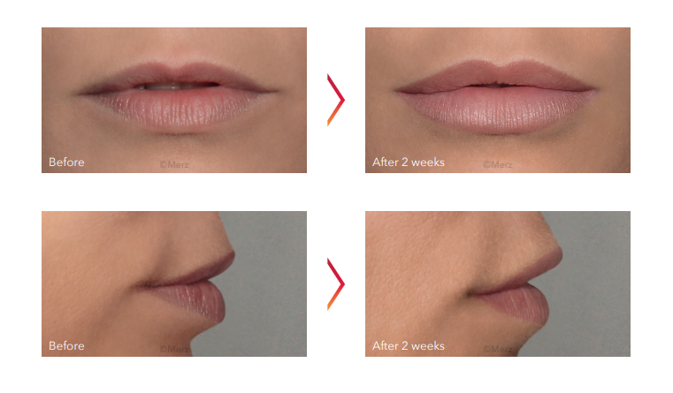 Belotero Lips Shape and Contour