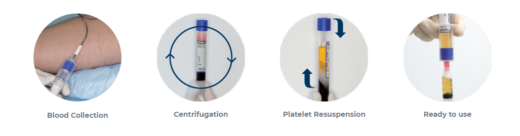 prp growth factor