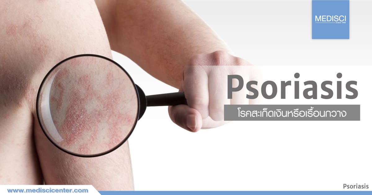 Psoriasis disease treatment