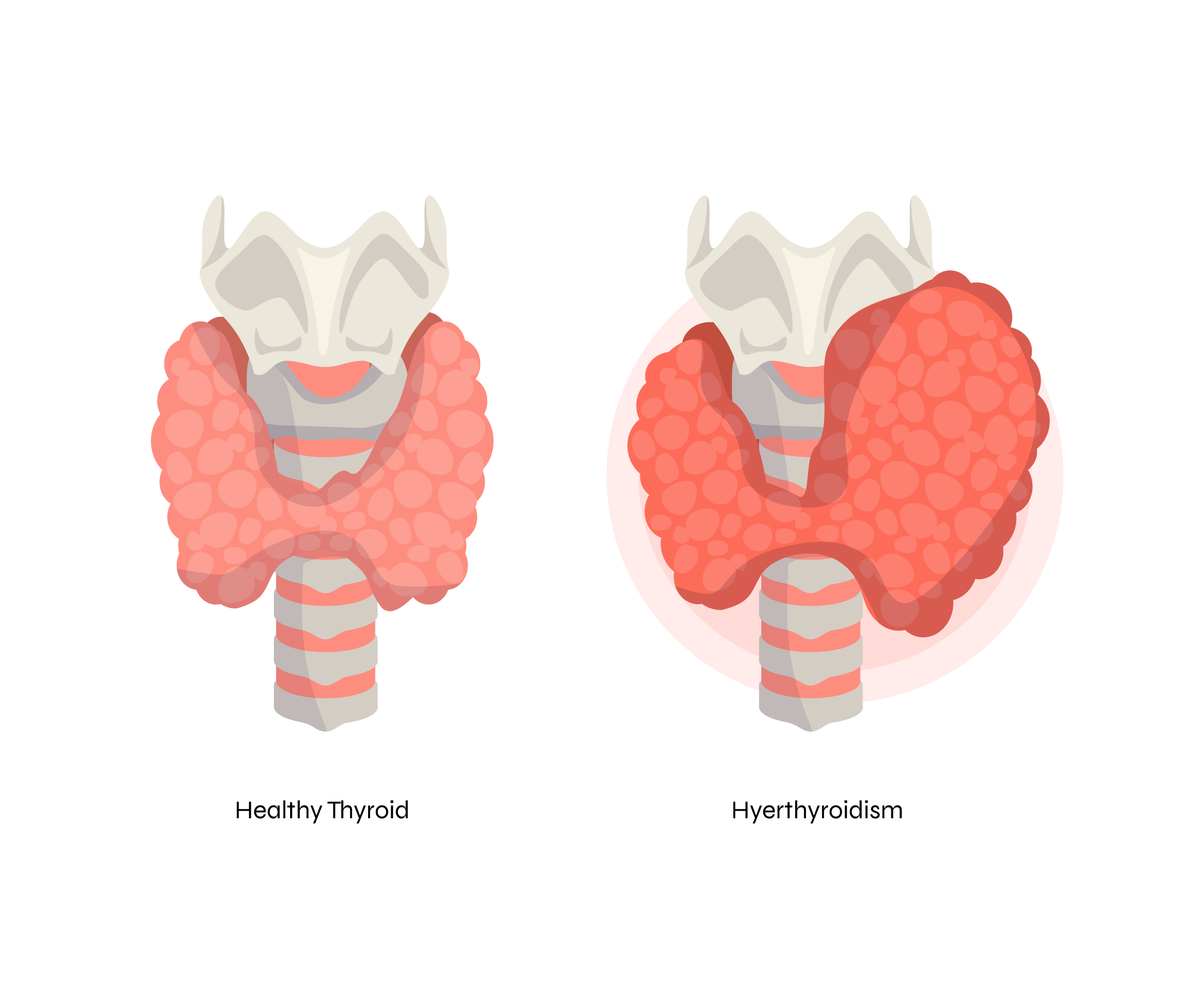 Thyroid Disease