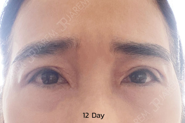 จาเรมคลินิก ทำตากับหมอยุ้ย