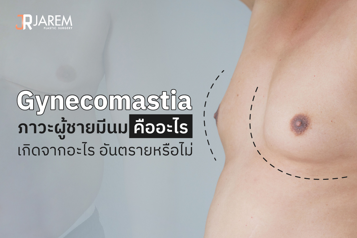 Gynecomastia คืออะไร