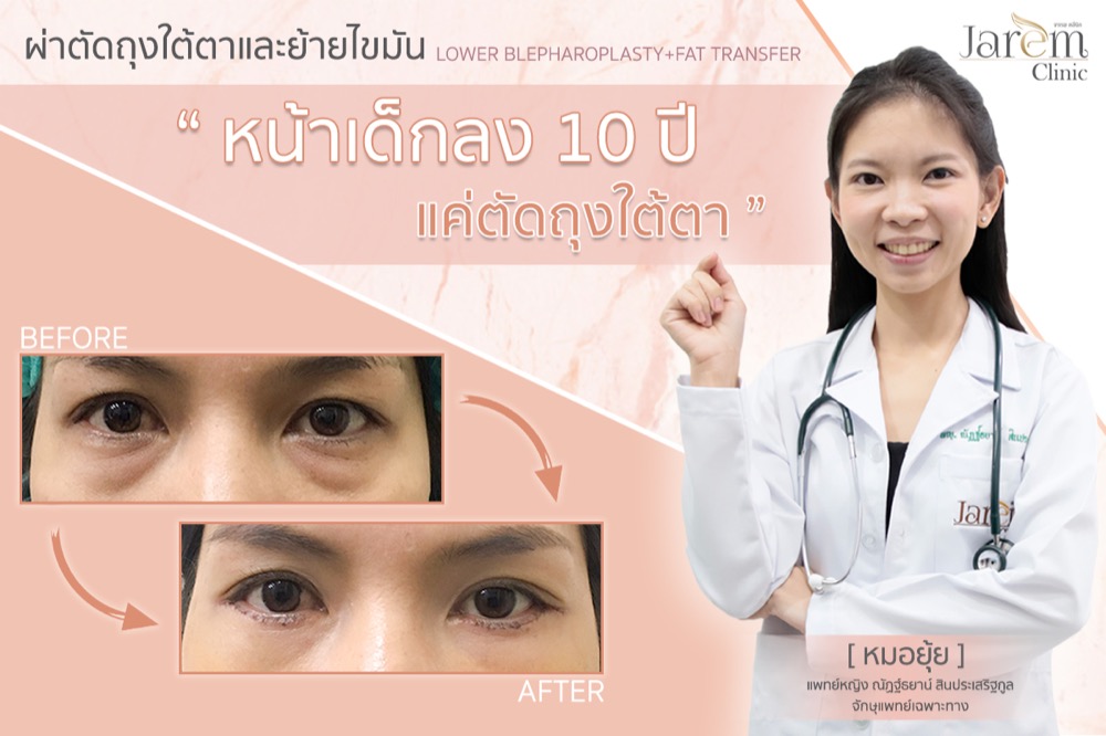 ผ่าตัดถุงใต้ตา เลอลักษณ์ ราคา