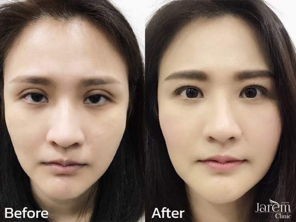 ptosis หลังแก้ตา