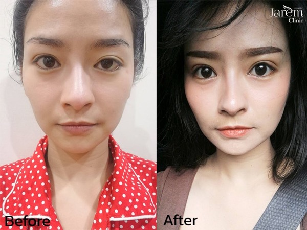 ptosis