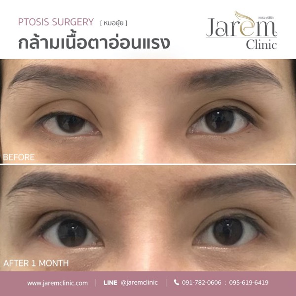 แก้ไข รักษา กล้ามเนื้อตาอ่อนแรง