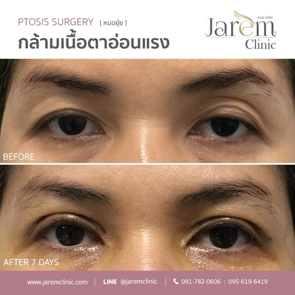 กล้ามเนื้อตาอ่อนแรง ภาษาอังกฤษ ptosis