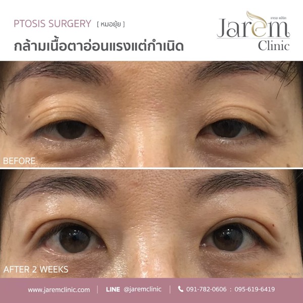 กล้ามเนื้อตาอ่อนแรง อาการ