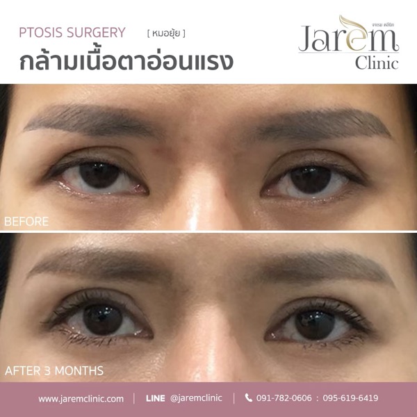 กล้ามเนื้อตาอ่อนแรง แก้ตาสองชั้น