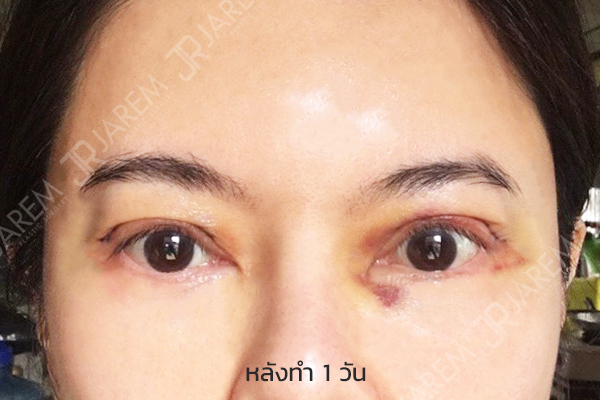 แก้ตา2ชั้น แก้ตา
