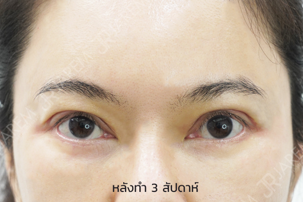 ศัลยกรรมตา โรคกล้ามเนื้อตาอ่อนแรง