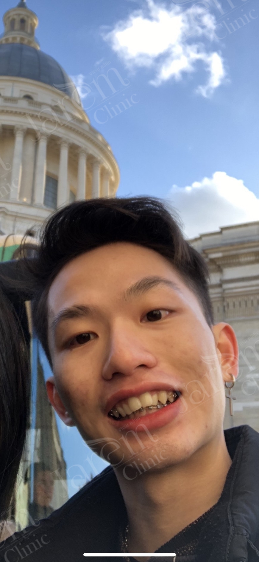 หนังตาตก