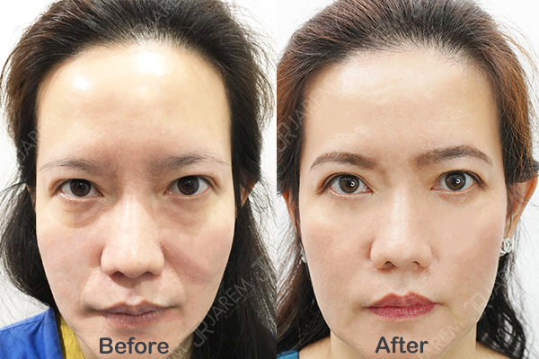ทำตากับหมอยุ้ย รีวิวแก้ตาสองชั้น