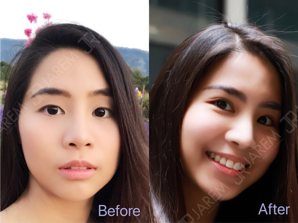before after ptosis