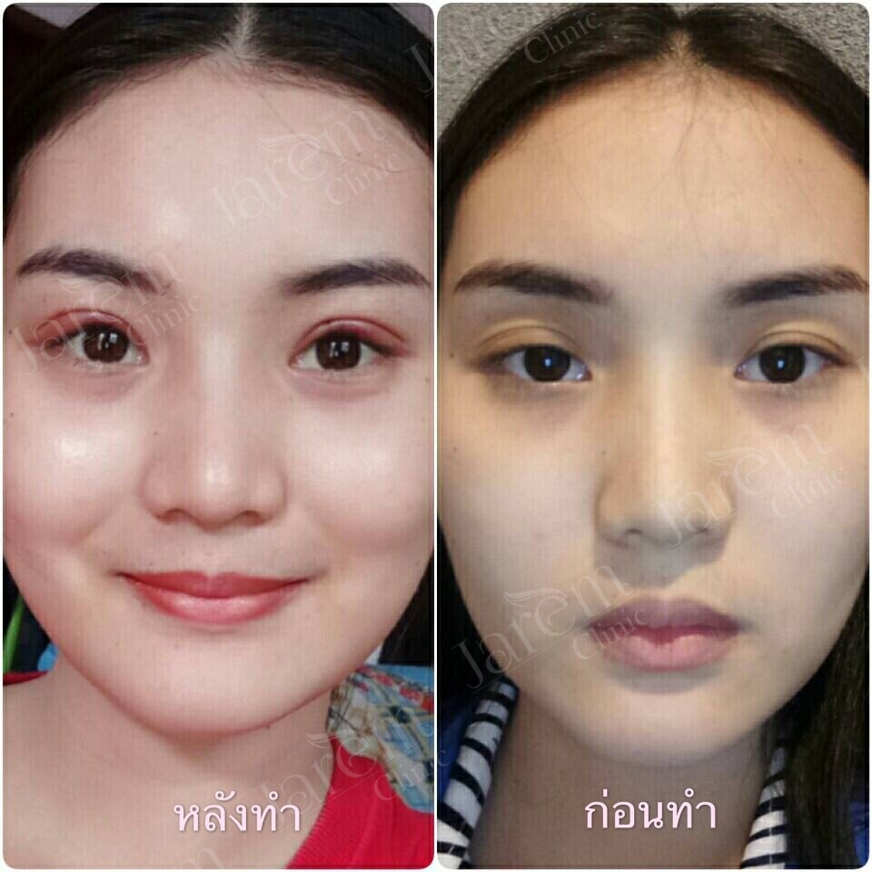 before after ตา