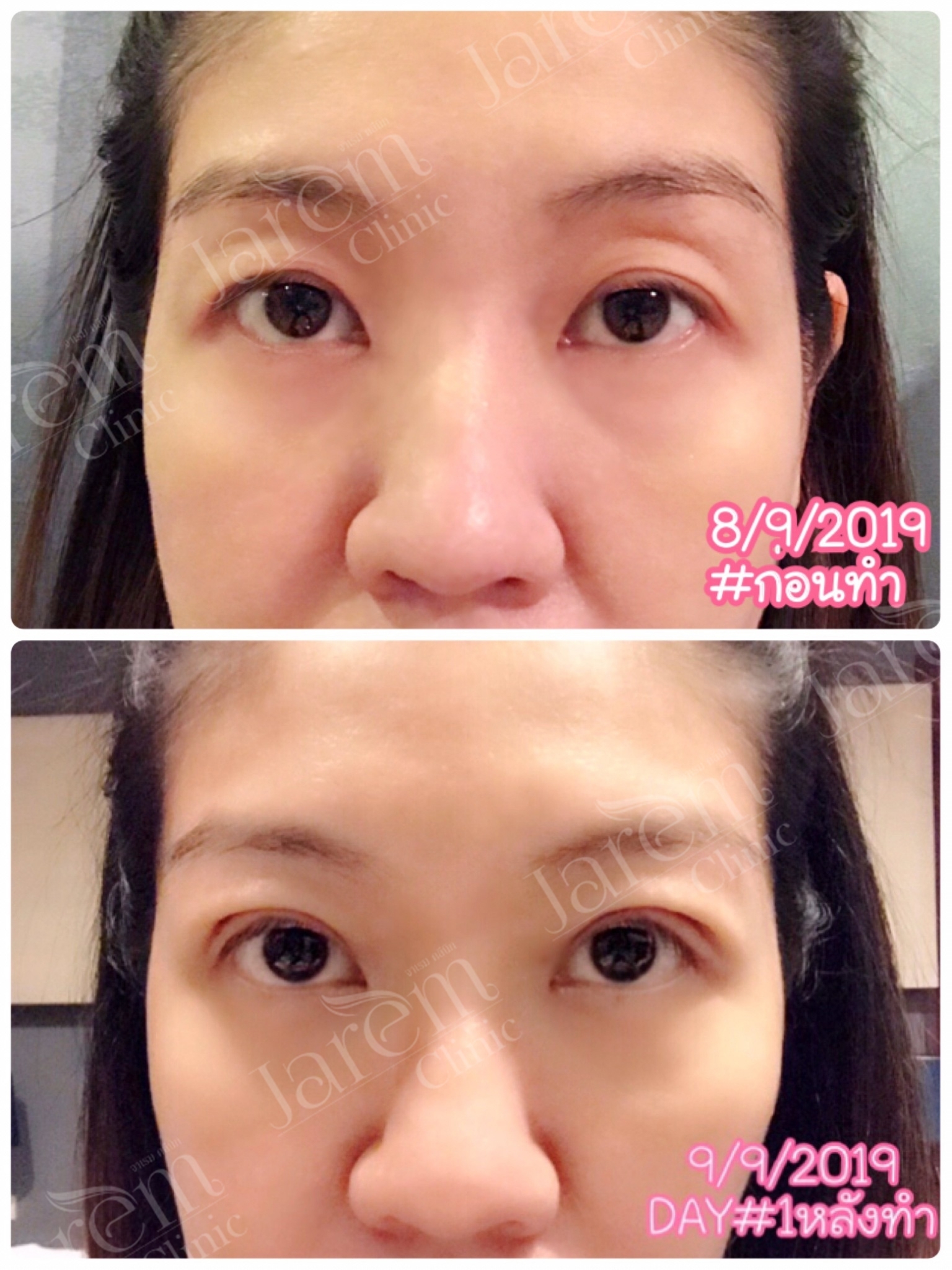 Before & After กล้ามเนื้อตาอ่อนแรง   