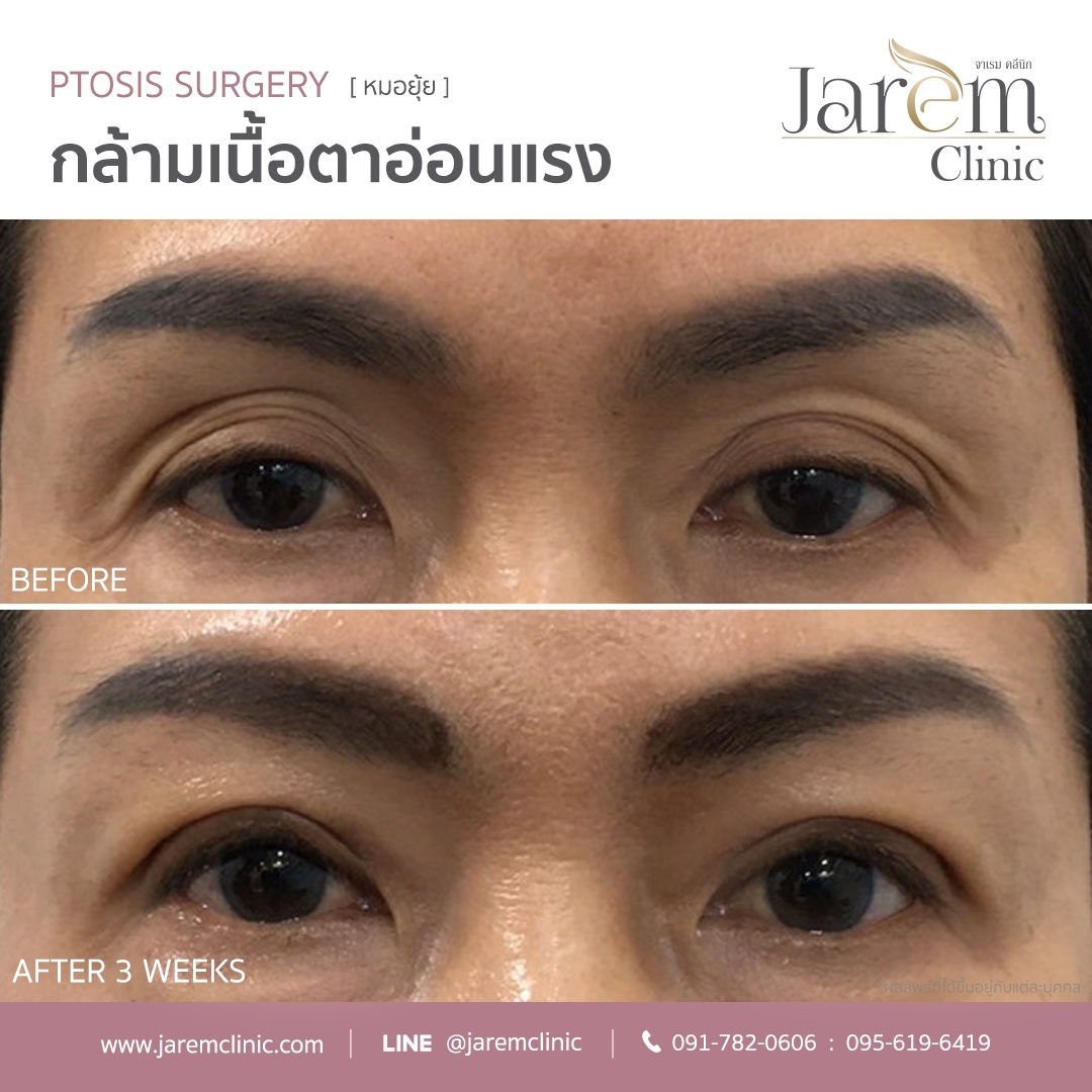 กล้ามเนื้อตาอ่อนแรงในผู้สูงวัย8