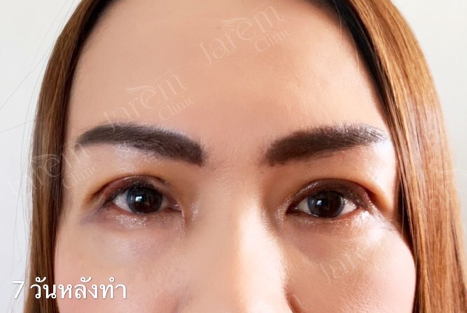 กล้ามเนื้อตาอ่อนแรงในผู้สูงวัย3