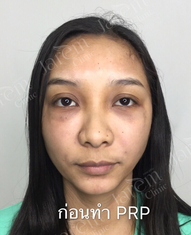 PRP 1