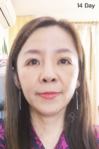 รีวิวกล้ามเนื้อตาอ่อนแรง รีวิวทำตาสองชั้น
