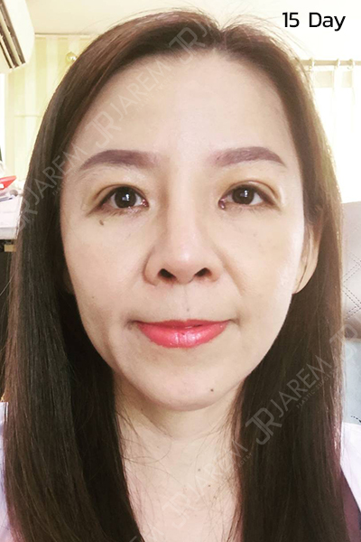 ภาวะกล้ามเนื้อตาอ่อนแรง รักษากล้ามเนื้อตาอ่อนแรง