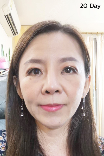 eyelid ptosis