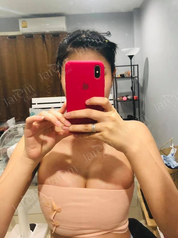 พักฟื้นหลังเสริมนม
