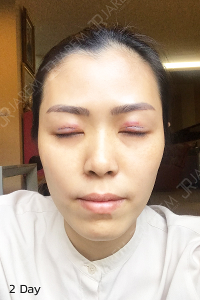 รีวิวศัลยกรรมตา ศัลยกรรมตา