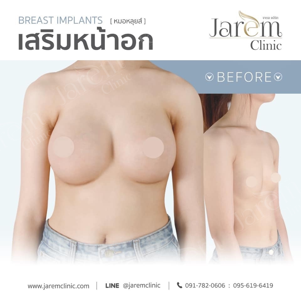 before after เสริมหน้าอก