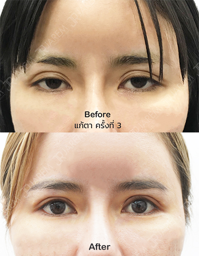 แก้ชั้นตา รีวิว แก้ตา
