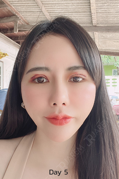แก้ตากับหมอยุ้ย แก้ตาครั้งที่3