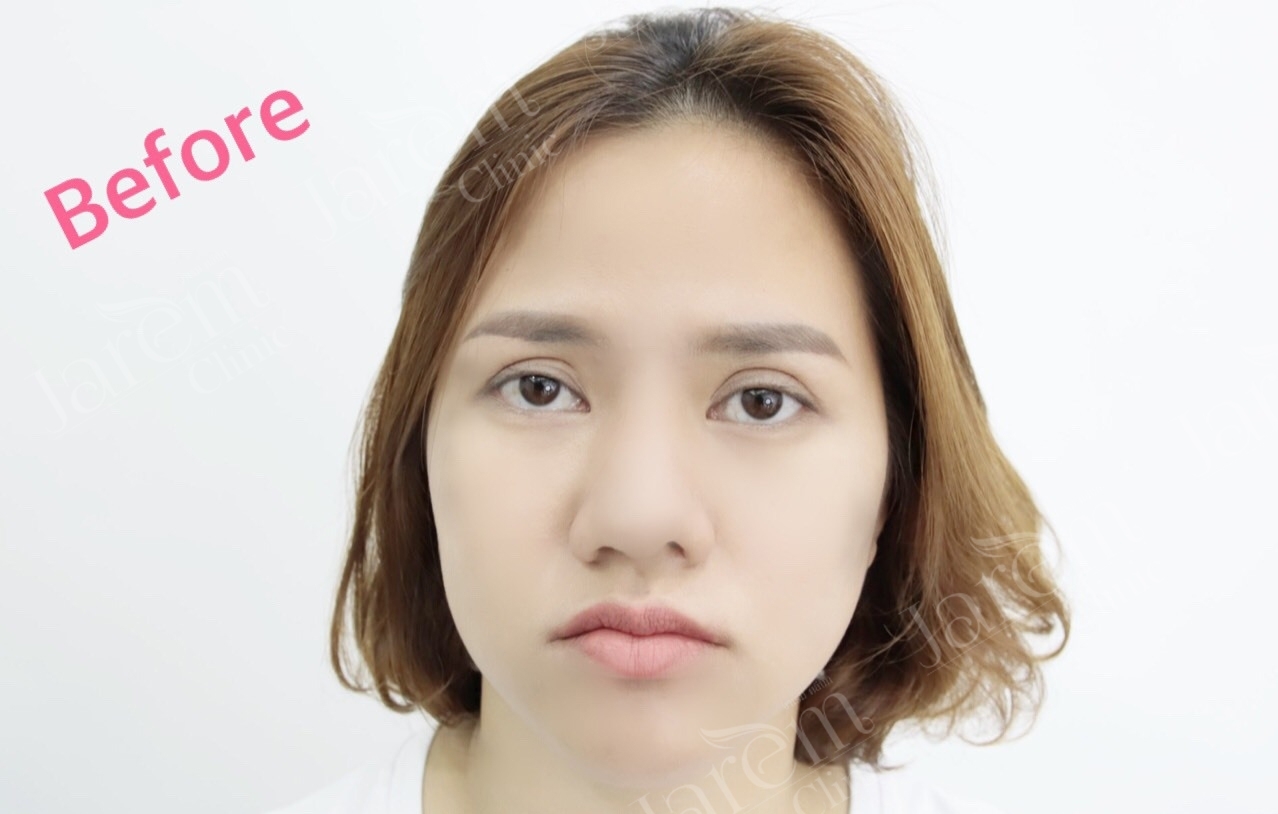 ตาปรือมาก