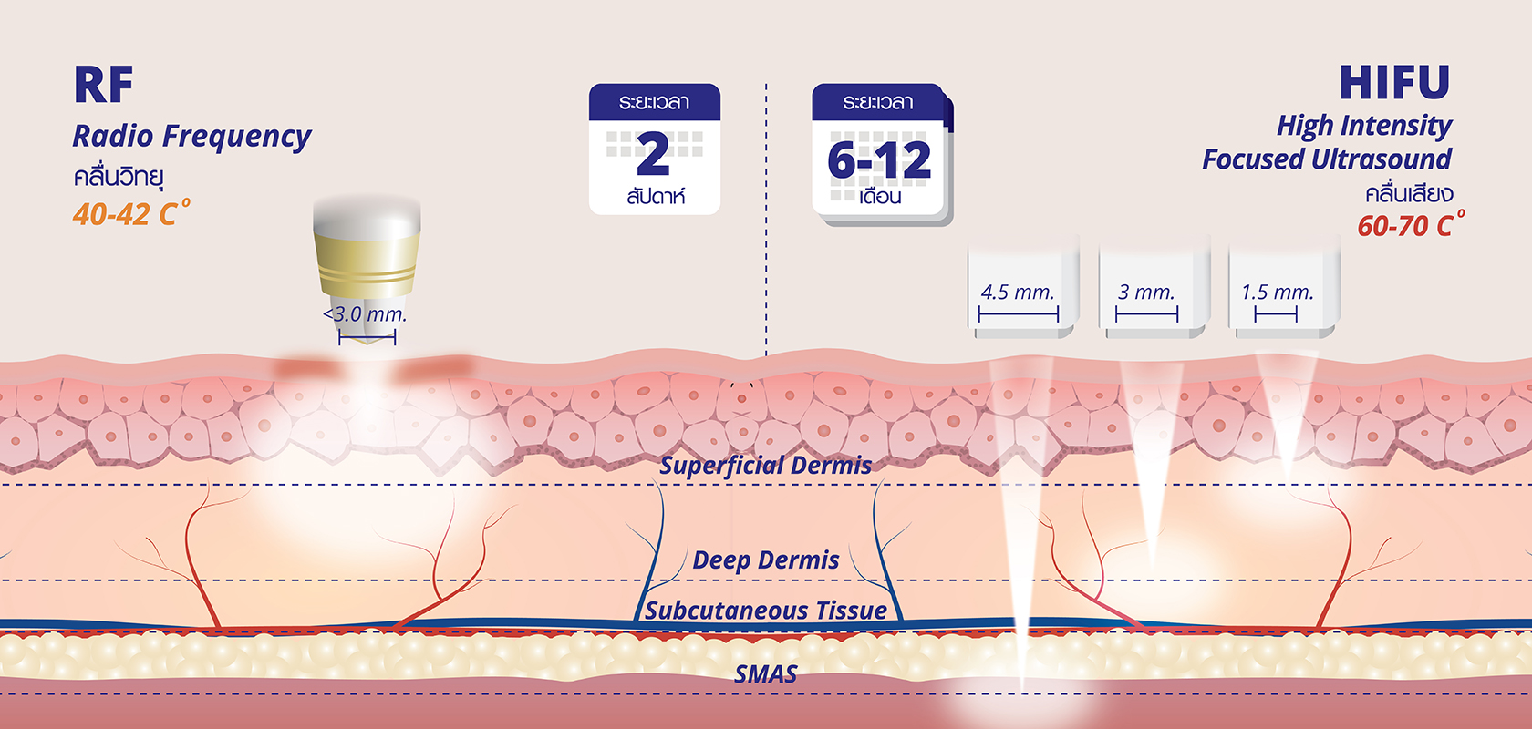 ไฮฟู (HIFU-Highly Intense Focused Ultrasound) - aestheclinicthailand