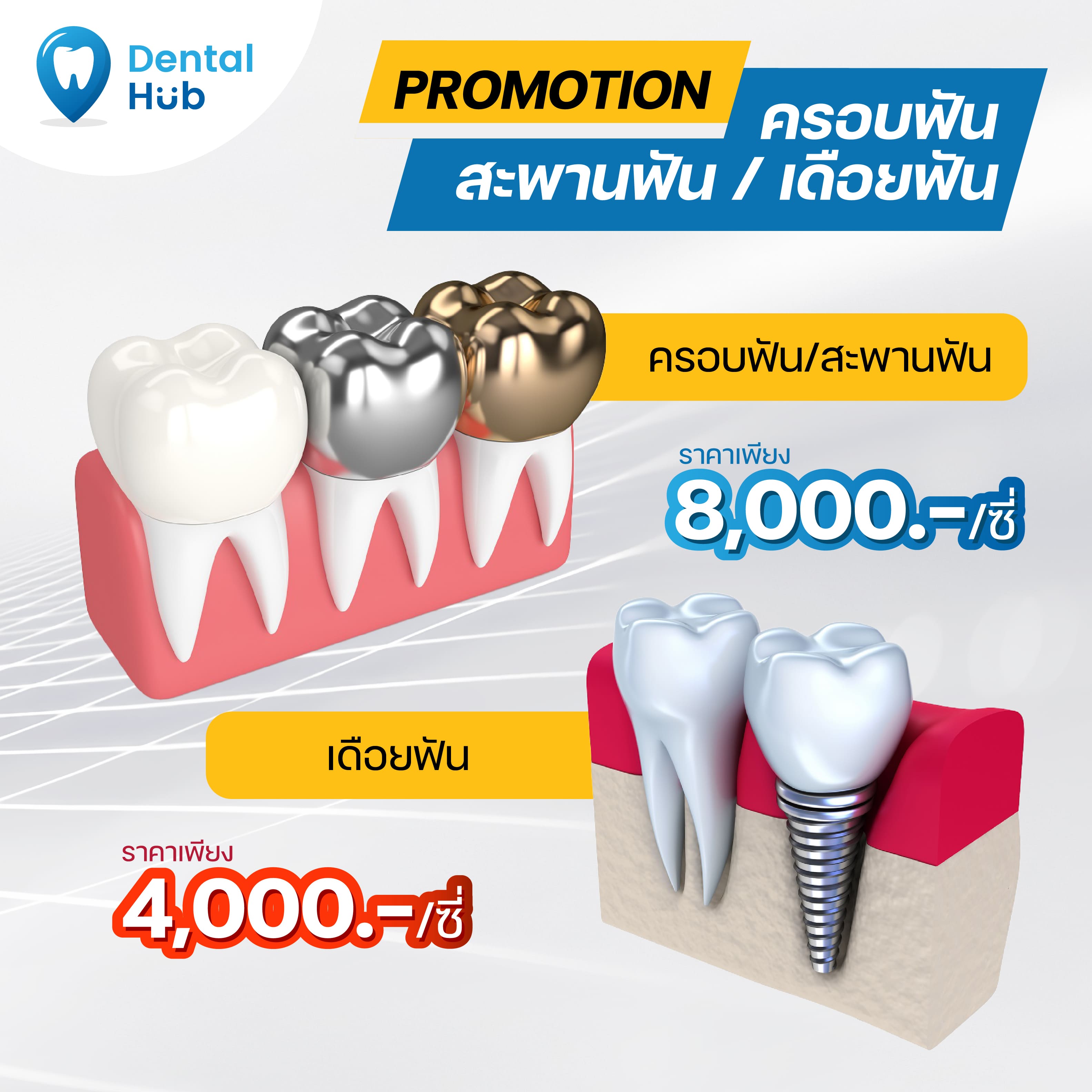 ครอบฟัน/สะพานฟัน/เดือยฟัน - dentalhubclinic