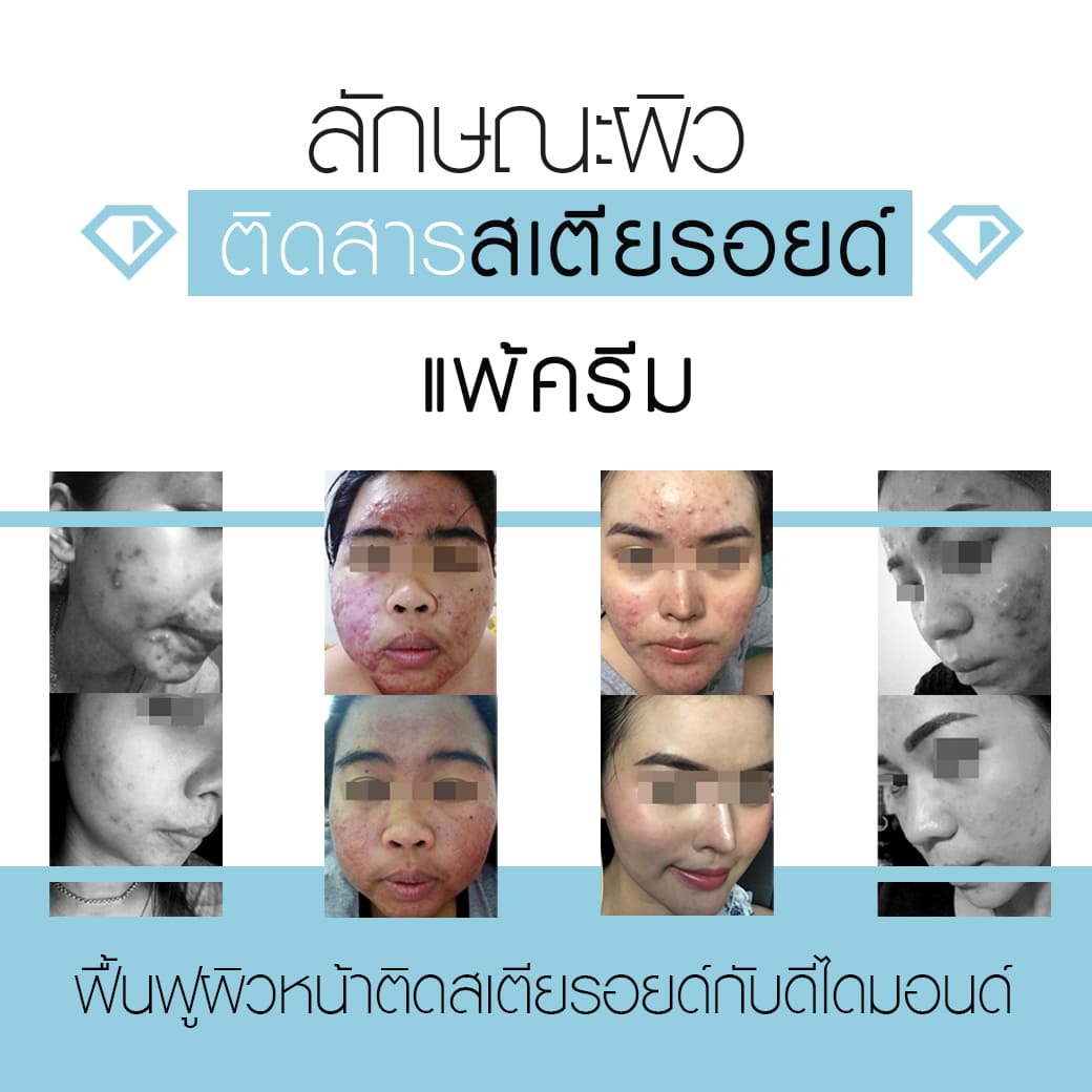 แพ้สารสเตียรอยด์ ใช้ครีมอะไรดี