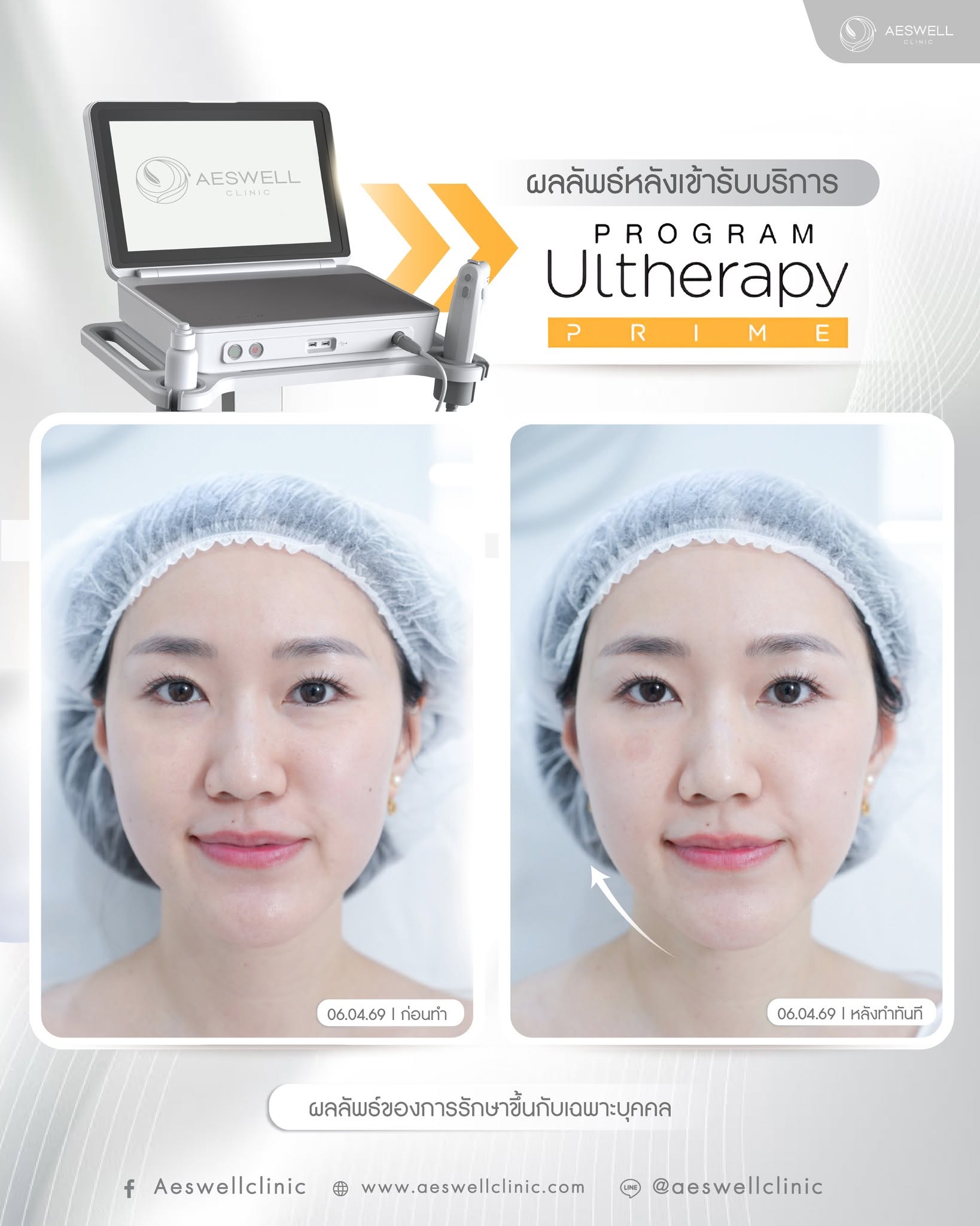 ผลลัพธ์หลังทำทันทีด้วย โปรแกรม Ultherapy Prime