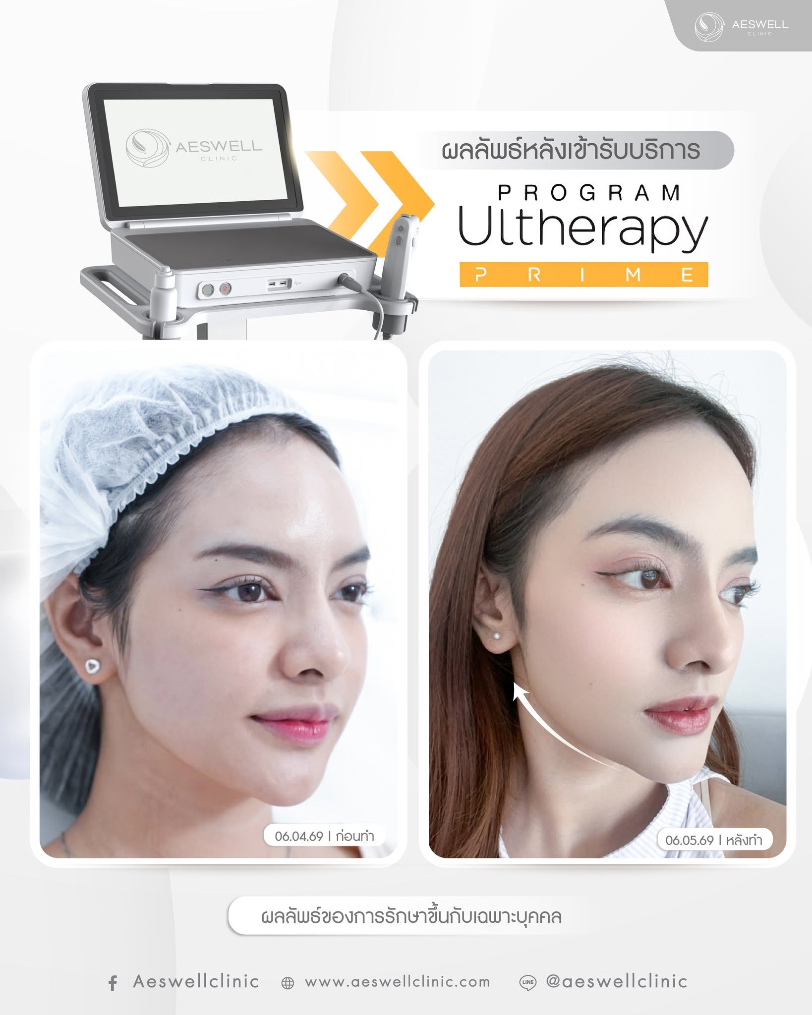 ผลลัพธ์หลังทำโปรแกรม Ultherapy Prime ครบ 1 เดือน