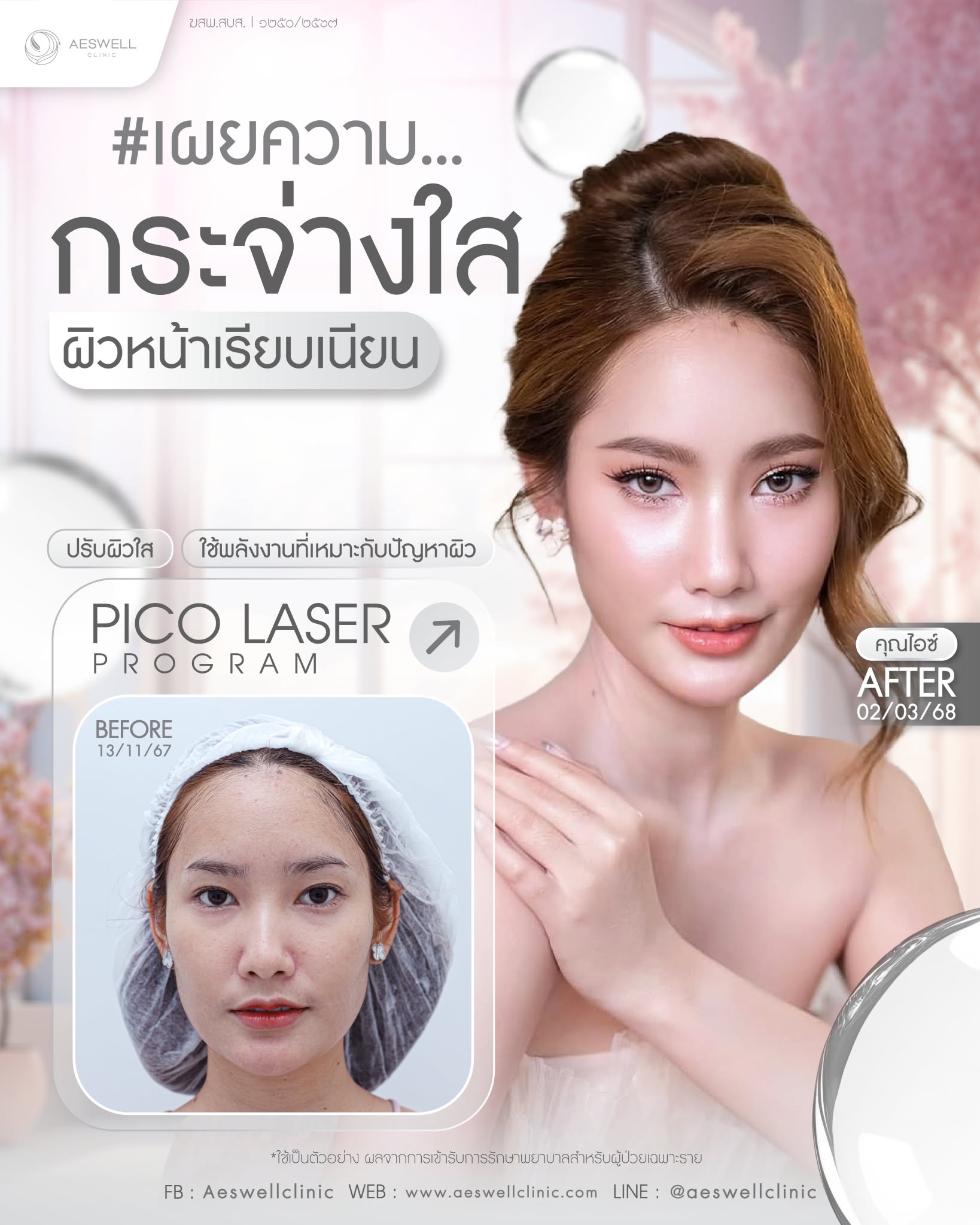 รีวิว pico laser