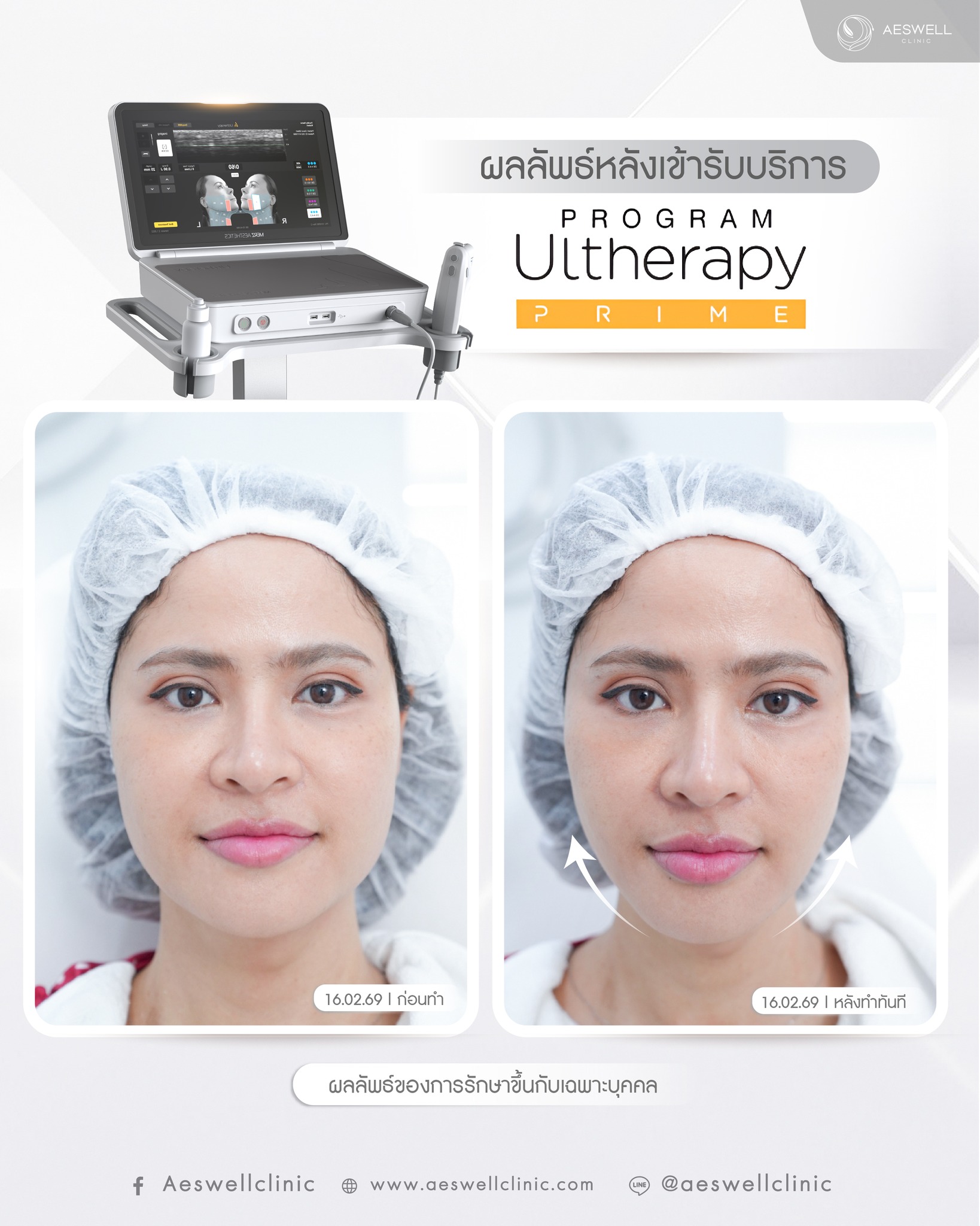 รีวิวการทำ โปรแกรม Ultherapy Prime