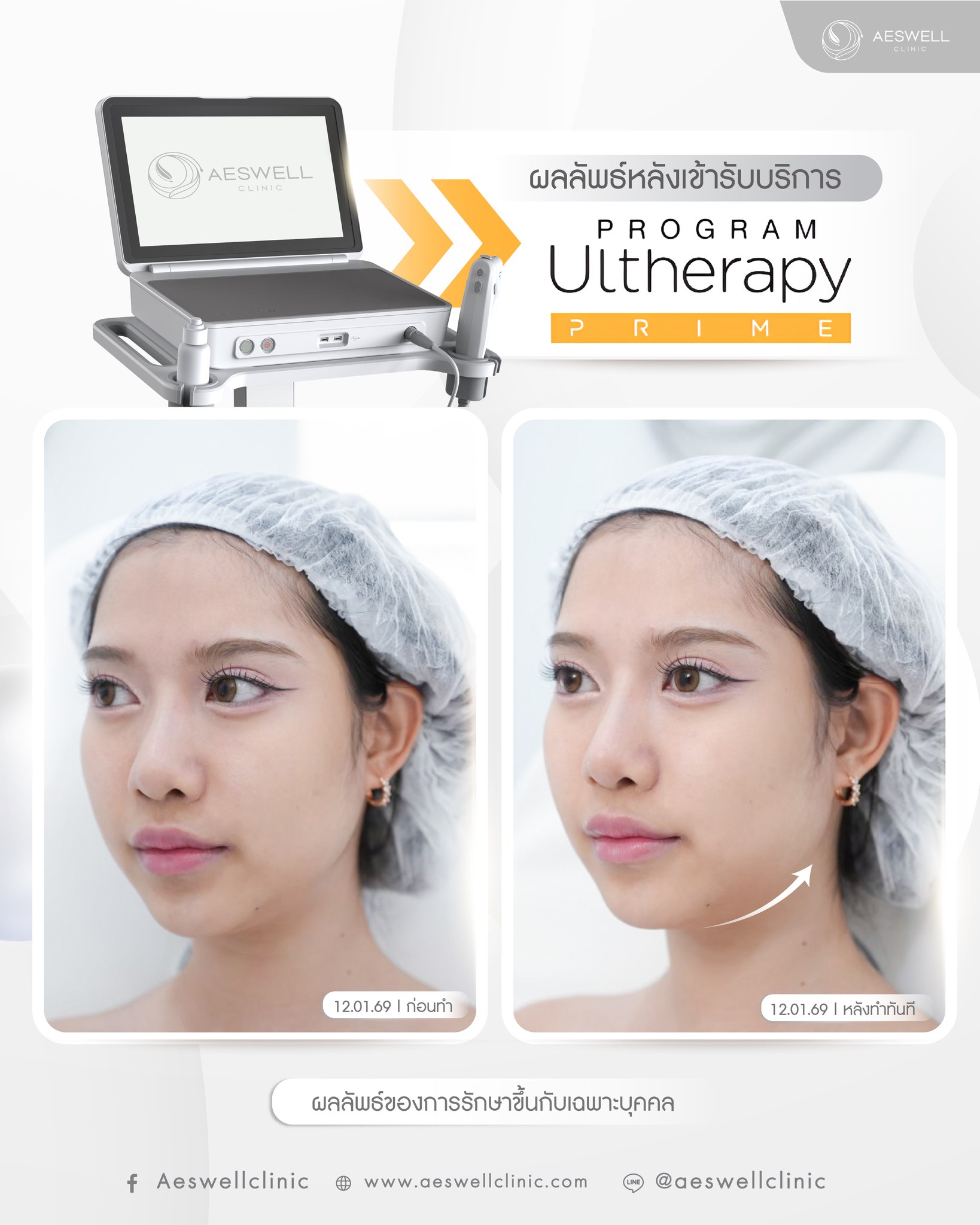 รีวิวการทำ โปรแกรม Ultherapy Prime