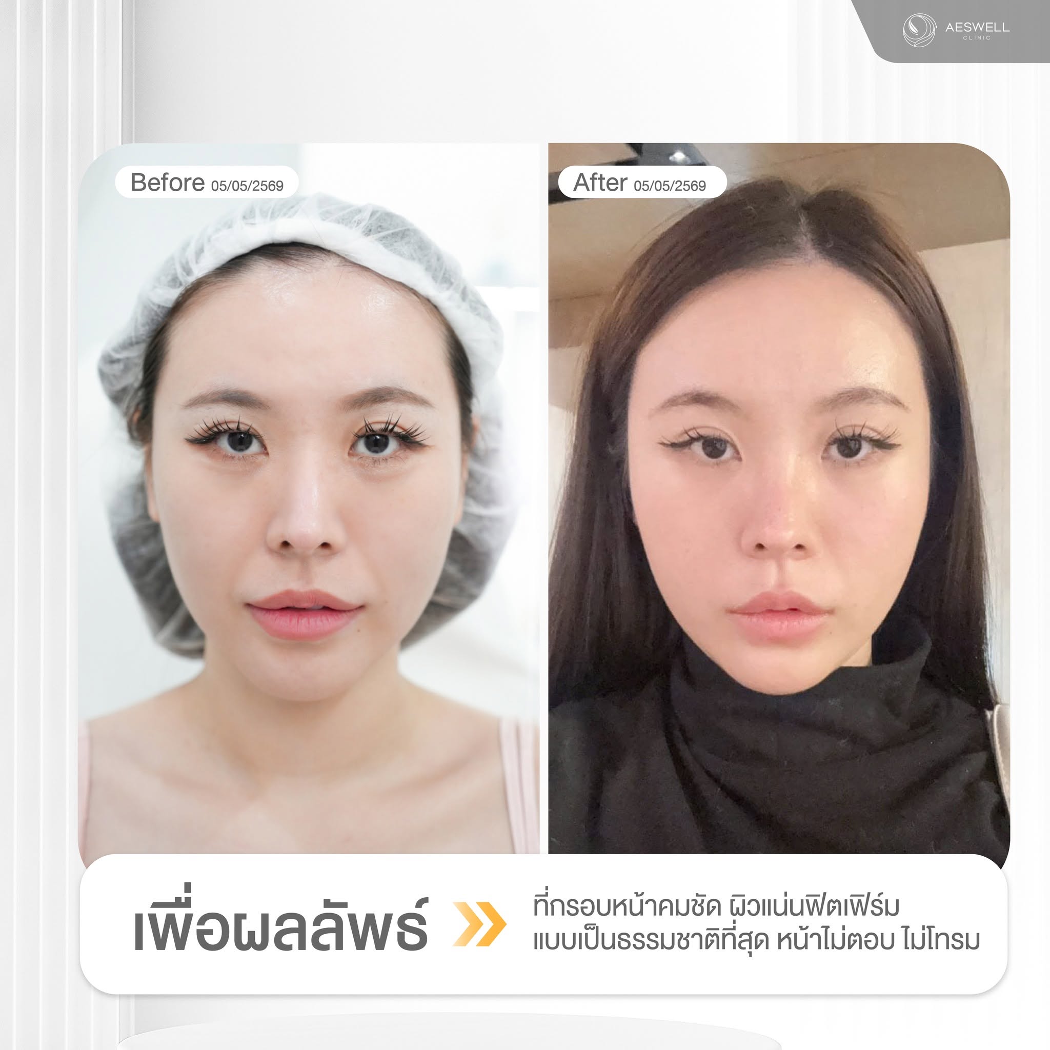 หลังทำโปรแกรม Oligio X