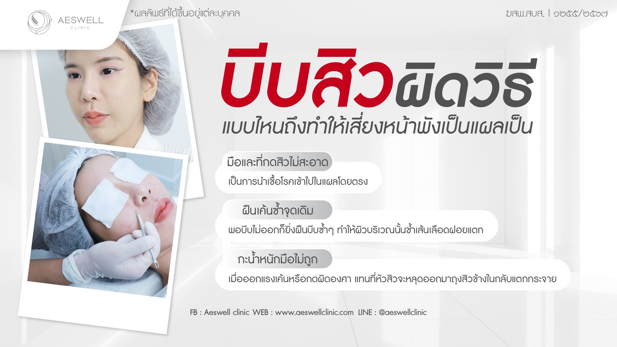 บีบสิวผิดวิธีแบบไหน ถึงทำให้เสี่ยงหน้าพังเป็นแผลเป็น