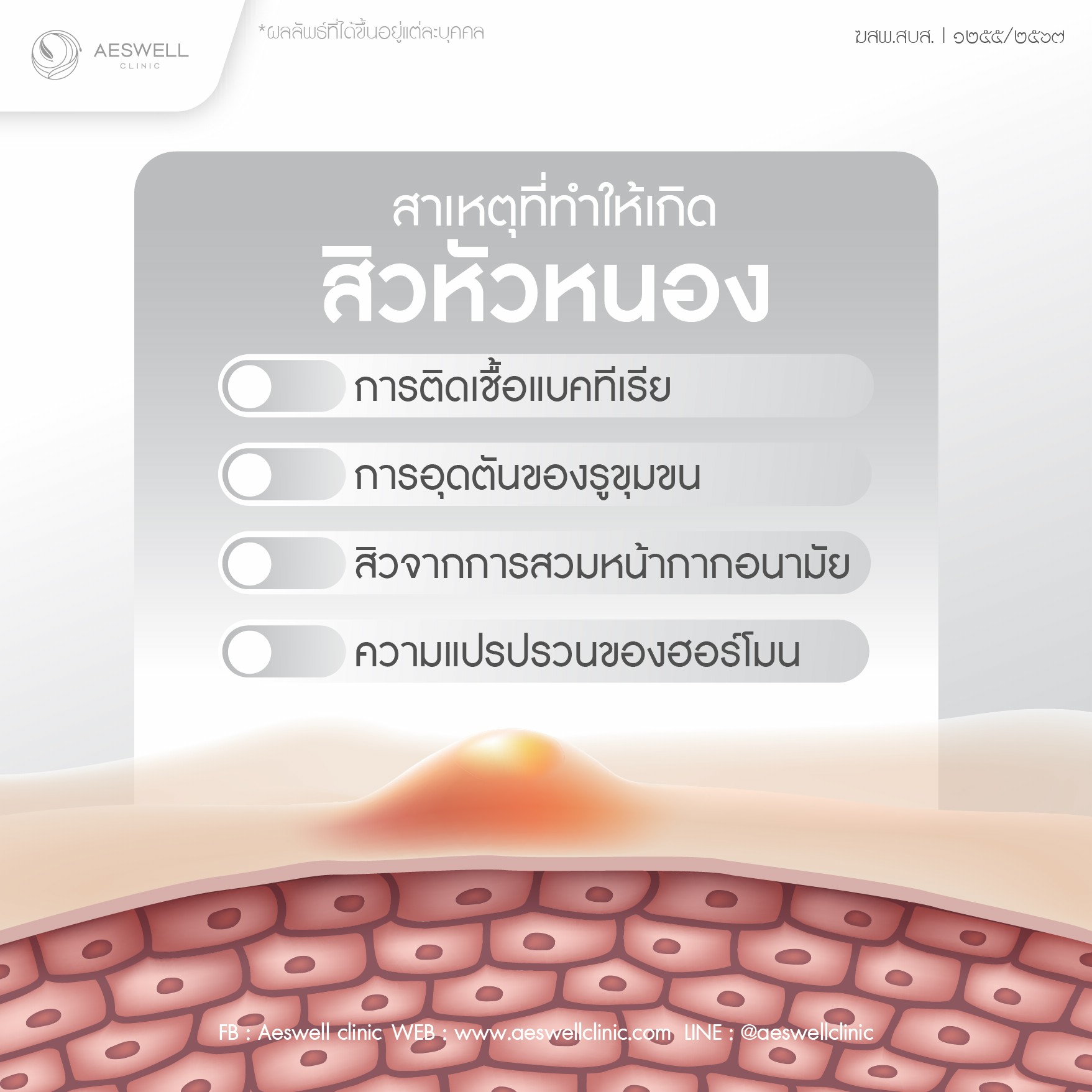 สิวหัวหนอง เกิดขึ้นที่บริเวณใดได้บ้าง