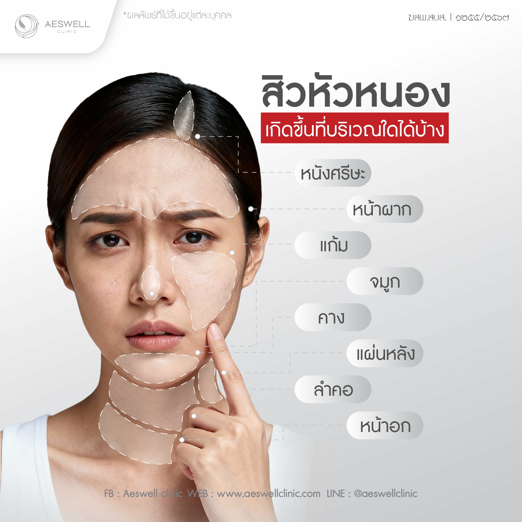 สาเหตุ ที่ทำให้เกิดสิวหัวหนอง