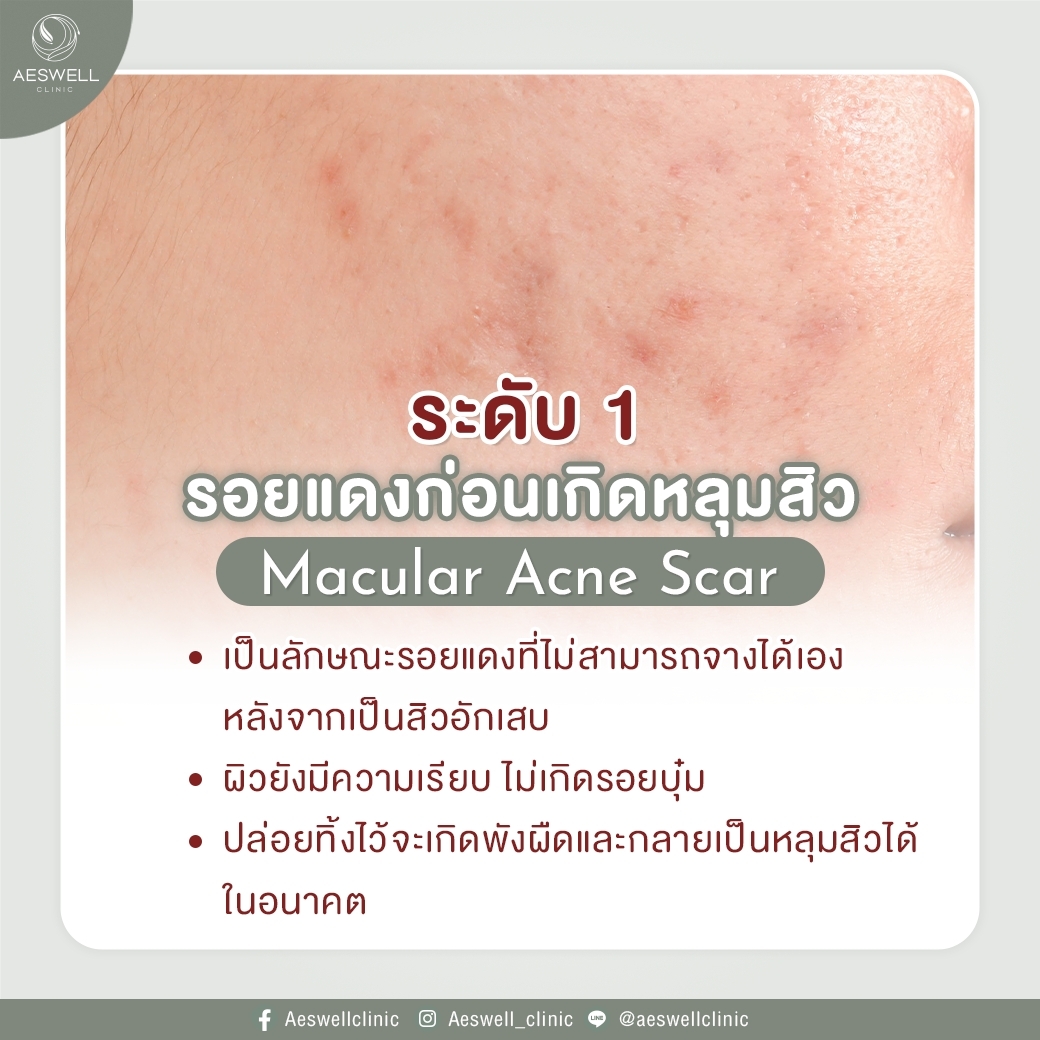 รอยแดงก่อนเกิดหลุมสิว รอยแดงก่อนเกิดหลุมสิว
