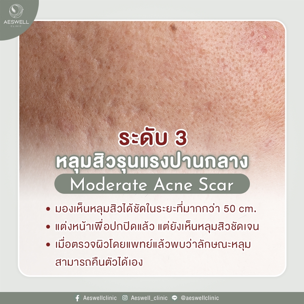หลุมสิวรุนแรงปานกลาง หลุมสิวรุนแรงปานกลาง
