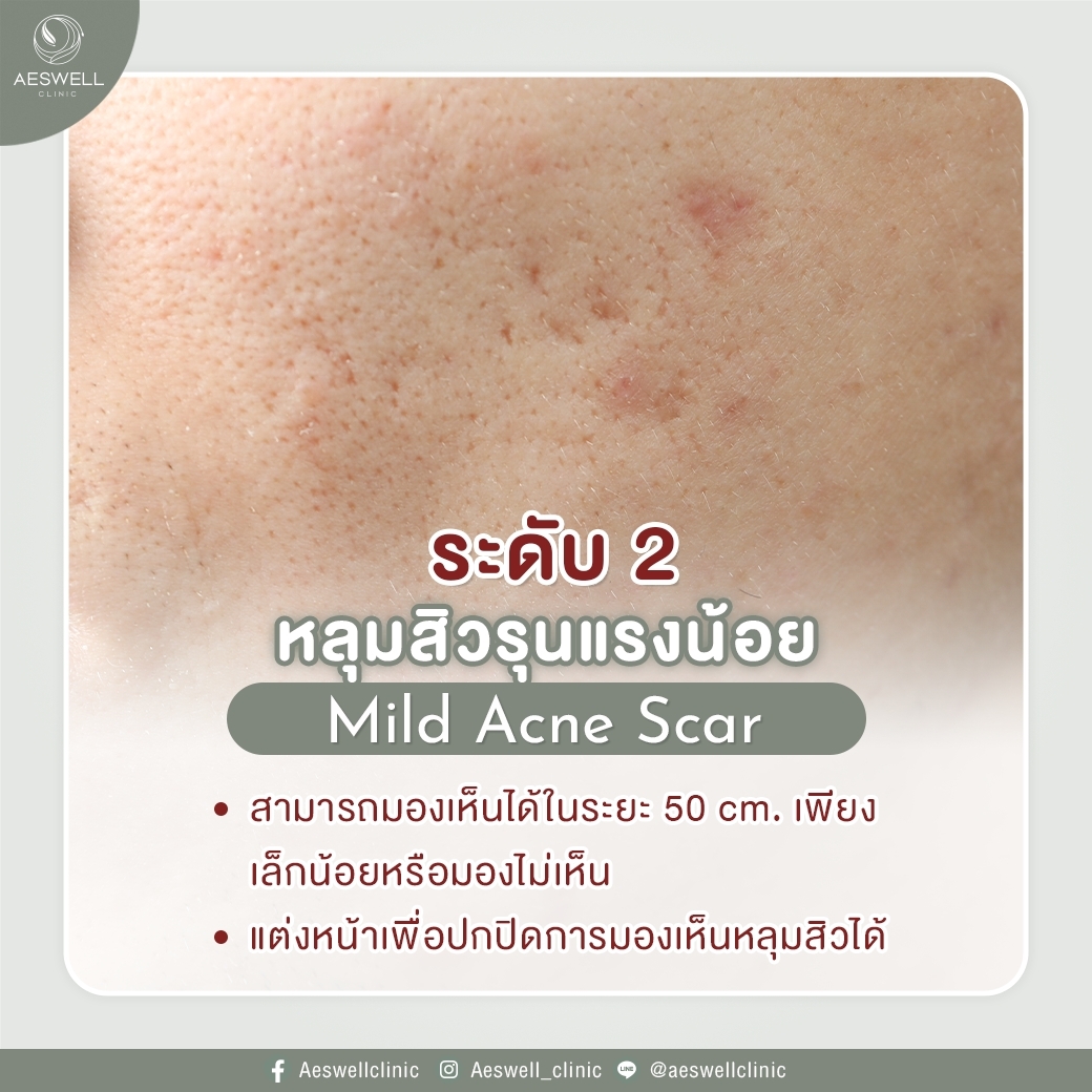 หลุมสิวรุนแรงน้อย หลุมสิวรุนแรงน้อย