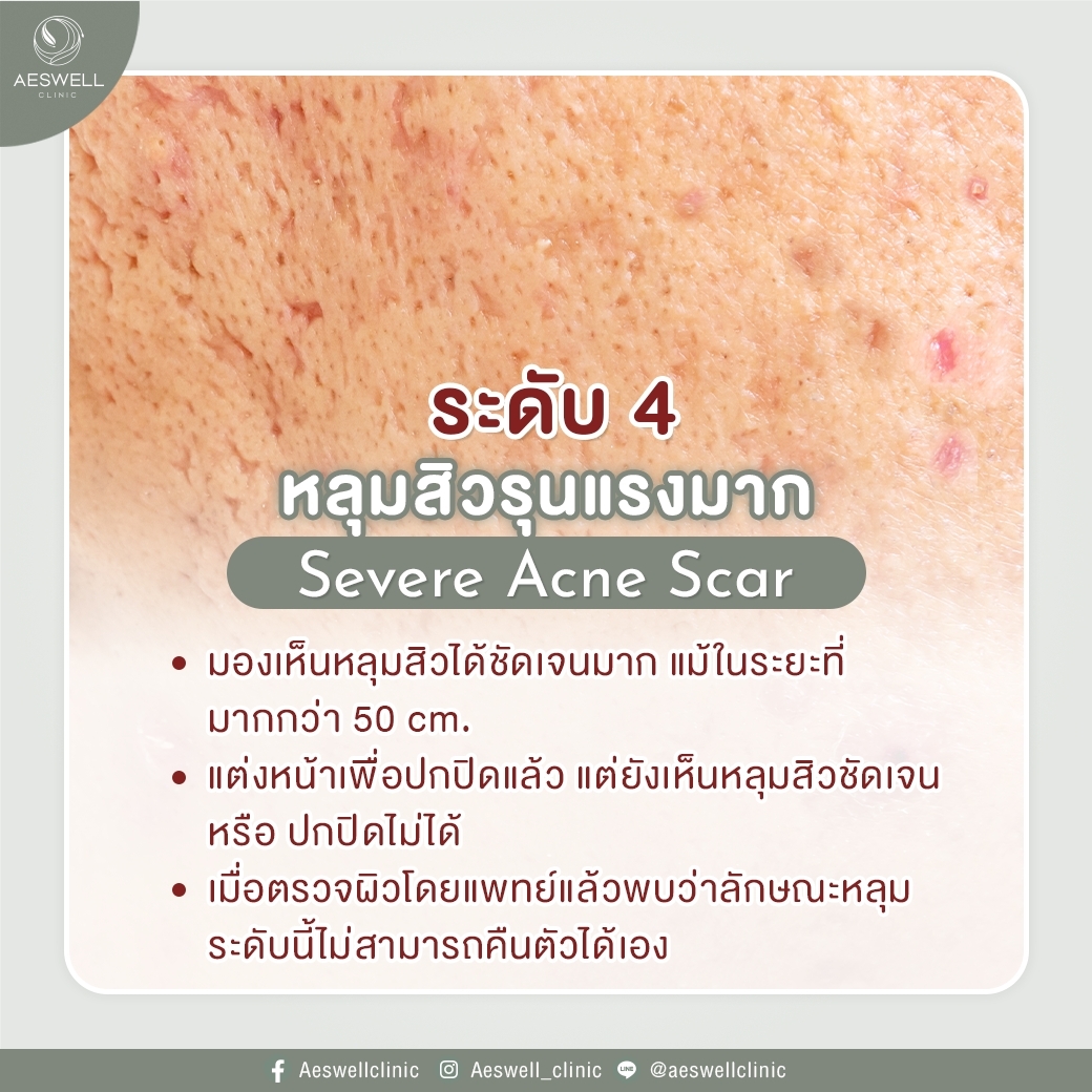 หลุมสิวรุนแรงมาก หลุมสิวรุนแรงมาก